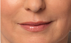Dermal Fillers West Chester