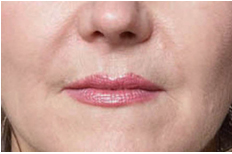 Dermal Fillers in West Chester