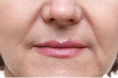 West Chester Dermal Fillers