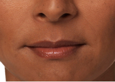 Dermal Fillers in West Chester