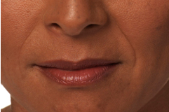 Dermal fillers West Chester