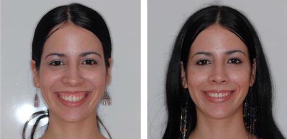 BOTOX in West Chester