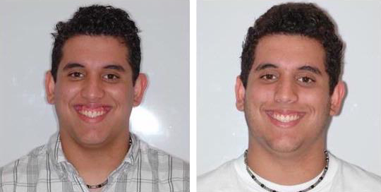 BOTOX Dentist in West Chester