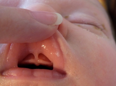 Lip Tie Treatment West Chester