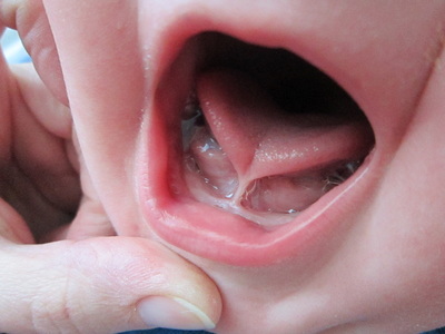 Tongue Tie Dentist 19382